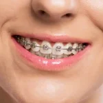 Understanding How Braces Correct Overbites and Underbites Through Biomechanical Forces