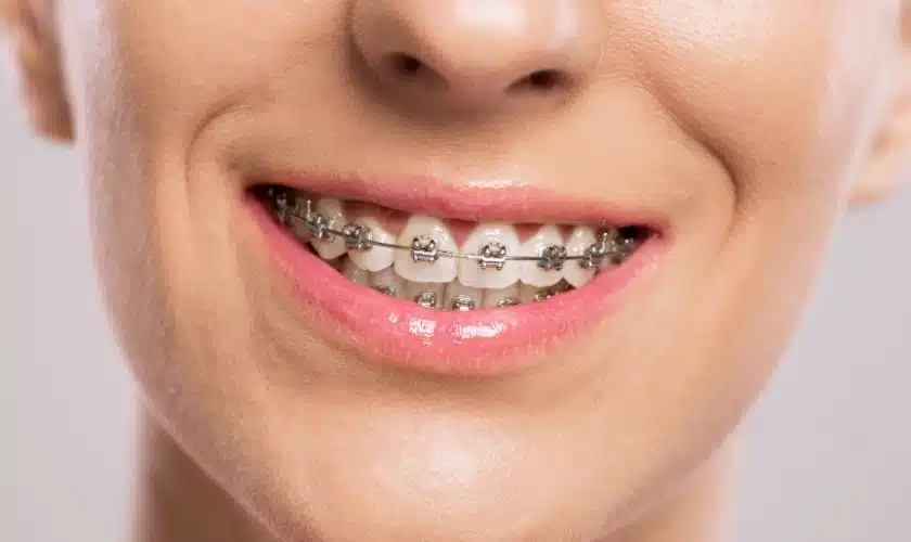 Understanding How Braces Correct Overbites and Underbites Through Biomechanical Forces